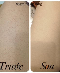 Alternative view of Kem giảm viêm nang lông Zaraporo Rohto 35g nội địa Nhật Bản - Kokubo